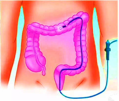 直腸癌早期有哪些癥狀？
